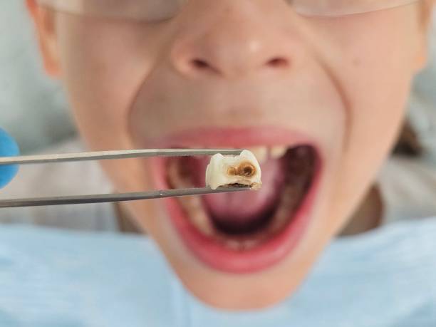 Teeth Whitening in NY